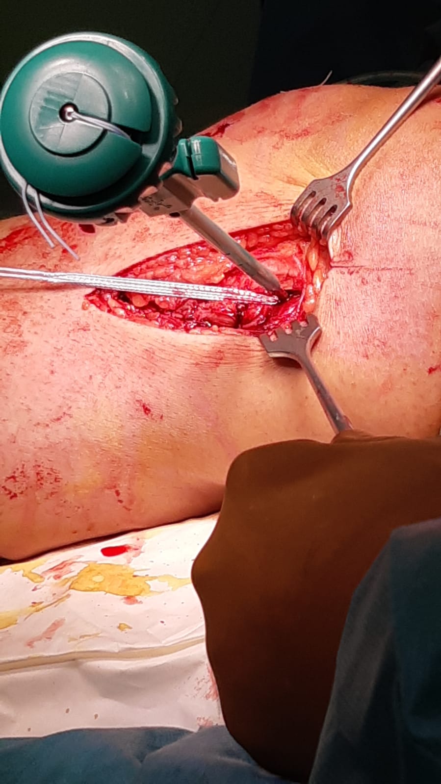1533 fnsp zazilinska ortopedia zaviedla novy typ operacie kolena jpg