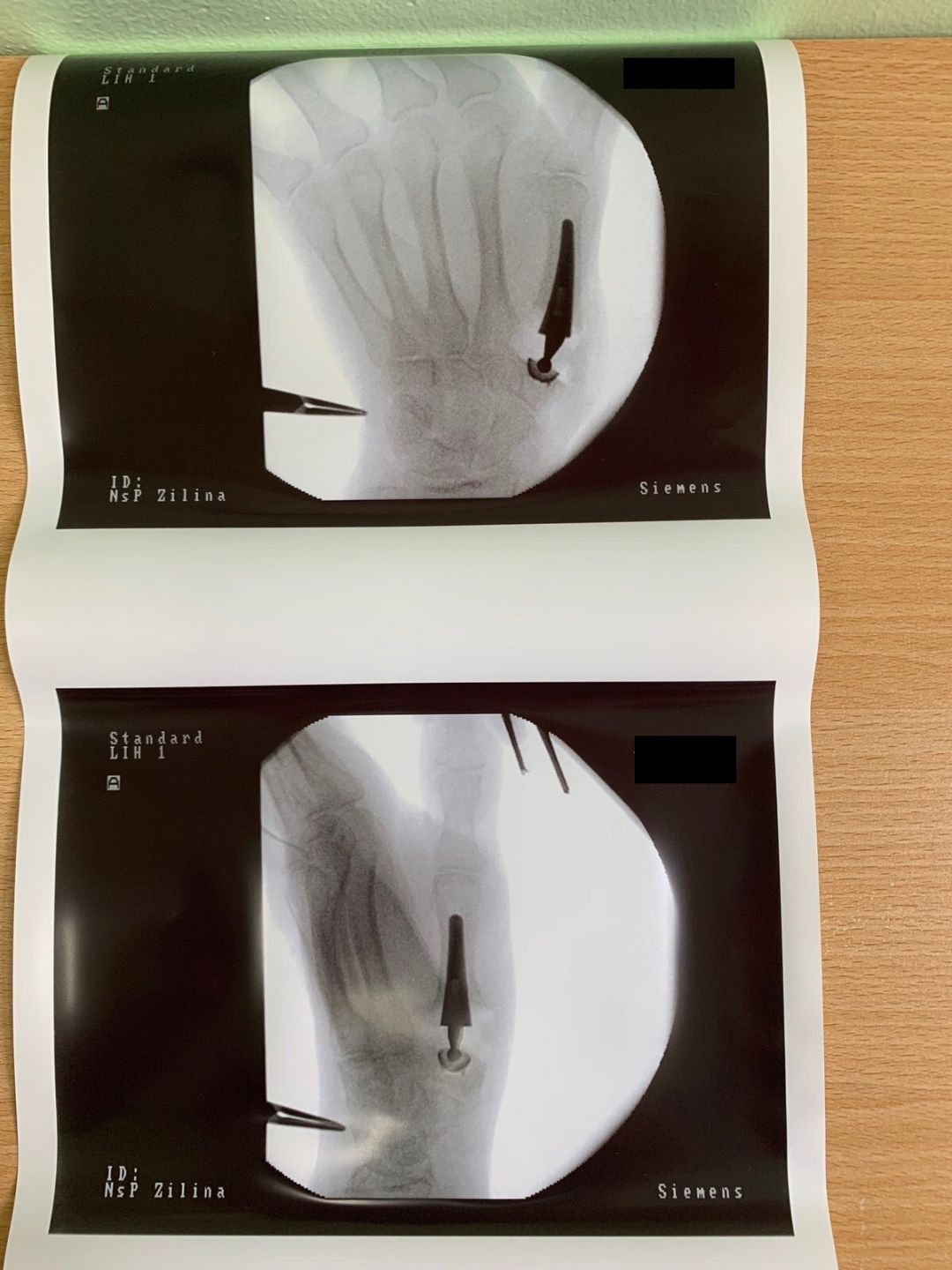 1736 fnsp zastav po implantacii jpg