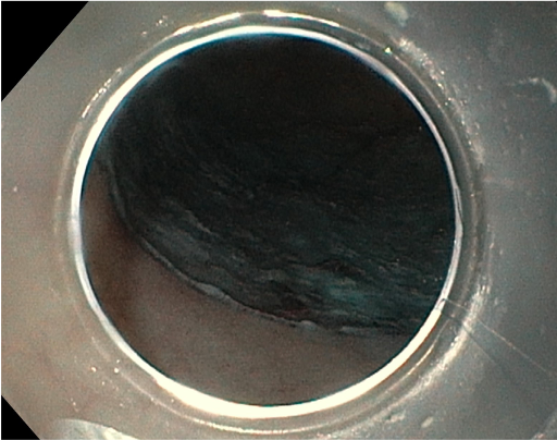 dissekcia b
